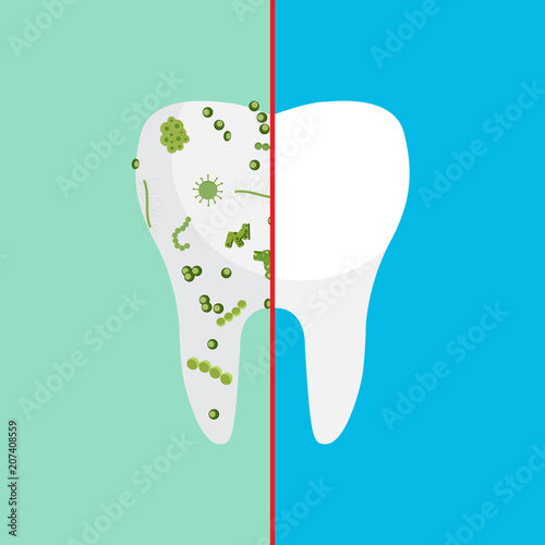 Vector illustration. Bacteria on a human white tooth being viewed on a magnifying glass.