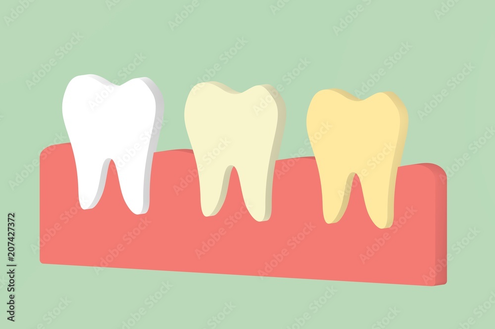white to yellow tooth, teeth whitening concept white to yellow tooth, teeth whitening concept