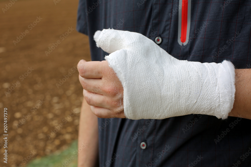 person with the thumb and wrist completely plastered after the f person with the thumb and wrist completely plastered after the f