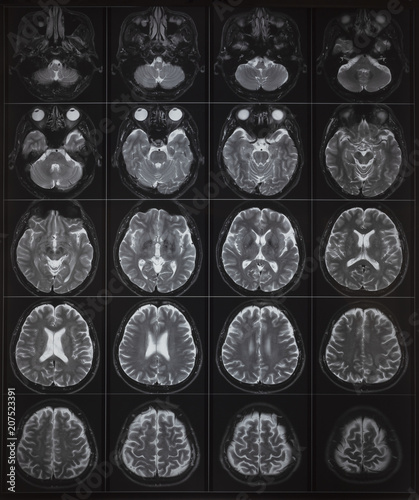 Human brain MRI on light box