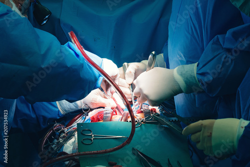 Konstfotografi Close up of open heart surgery cardiopulmonary bypass, minimal invasive cardiac surgery, cannulation techniques