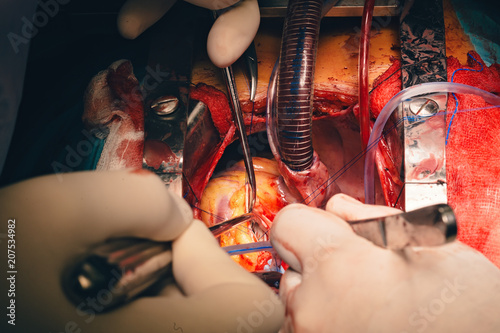 cardiovascular surgery team surgeons in surgery center for interventions with instruments in surgeon operation electrosurgery with thoracotomy microsurgery doing minimal invasive open heart surgery photo
