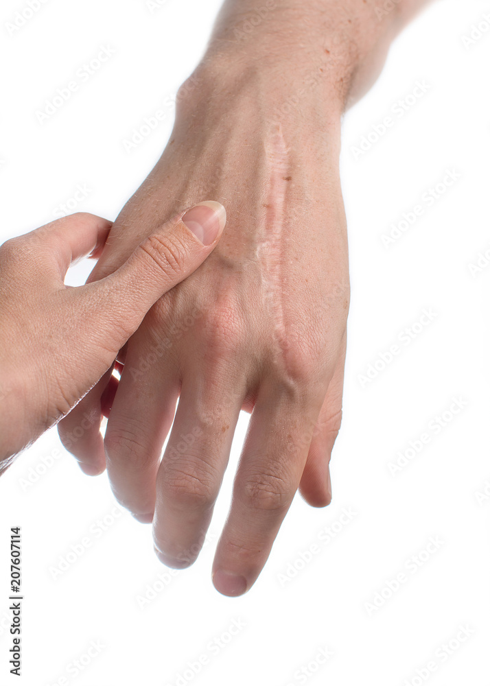 Big scar on male hand after chainsaw injury. Huge wound cicatrix close up.