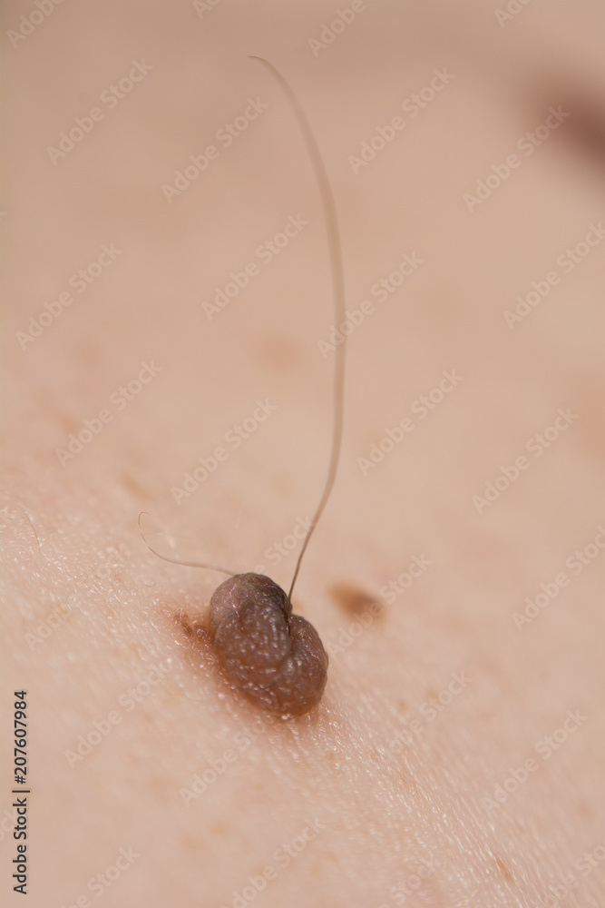 Inborn mole close up. Macro shot of benign skin lesion. Proliferation of pigment derma cells, melanocytic pigmented naevus, naevocytic nevus.