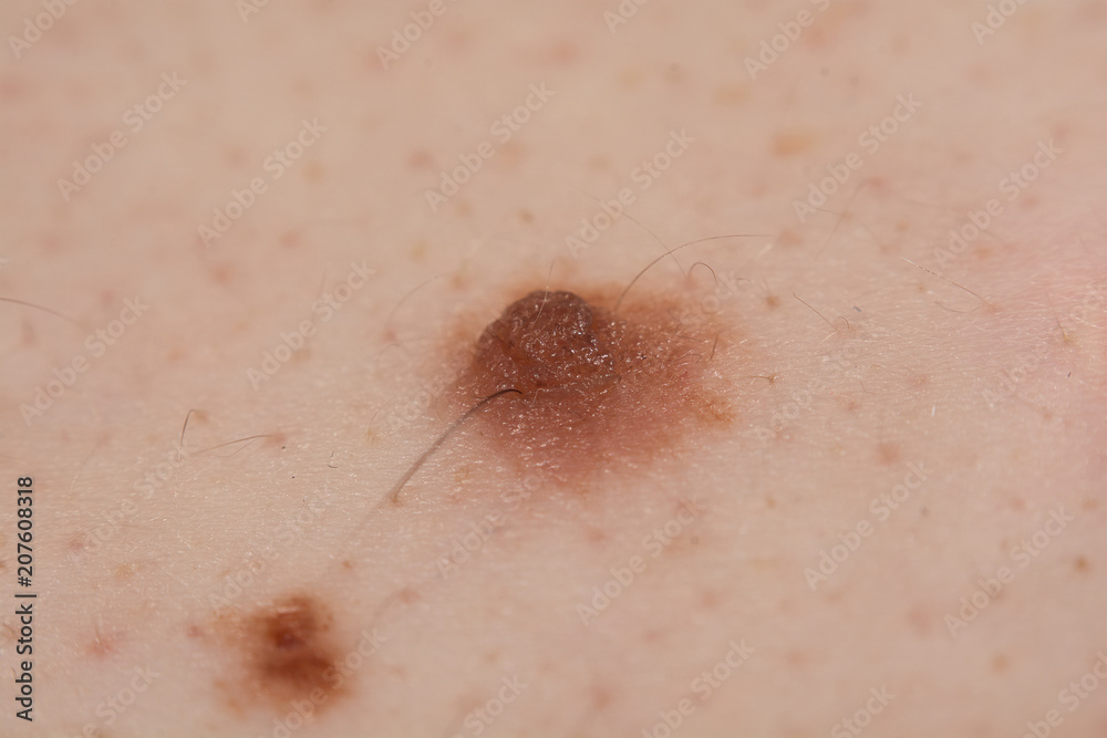 Inborn mole close up. Macro shot of benign skin lesion. Proliferation of pigment derma cells, melanocytic pigmented naevus, naevocytic nevus.