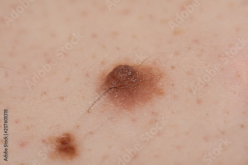 Obraz na płótnie Inborn mole close up. Macro shot of benign skin lesion. Proliferation of pigment derma cells, melanocytic pigmented naevus, naevocytic nevus. w salonie