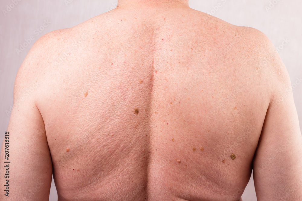 the doctor examines the birthmarks on the man's body the doctor examines the birthmarks on the man's body