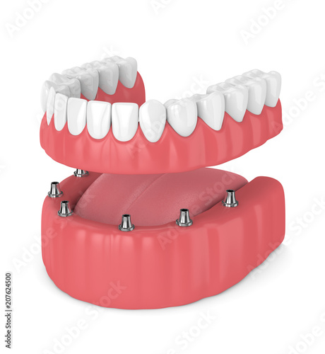 3d render of removable full implant denture