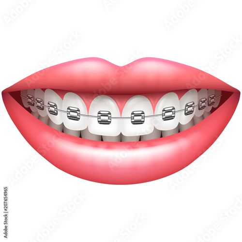 Teeth with braces woman smile isolated on white vector