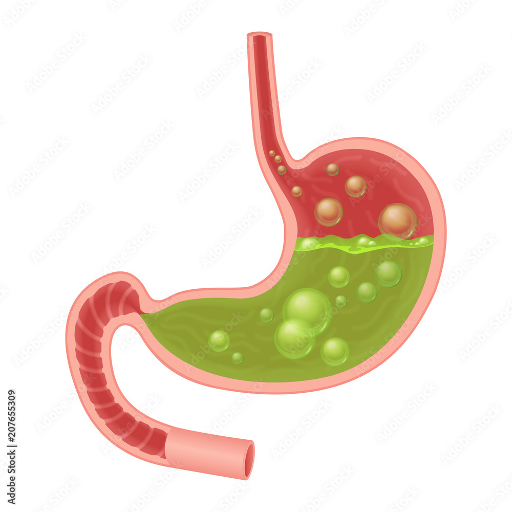Fototapeta premium Realistic medical illustration of nausea stomach isolated. Green liquid inside stomach.