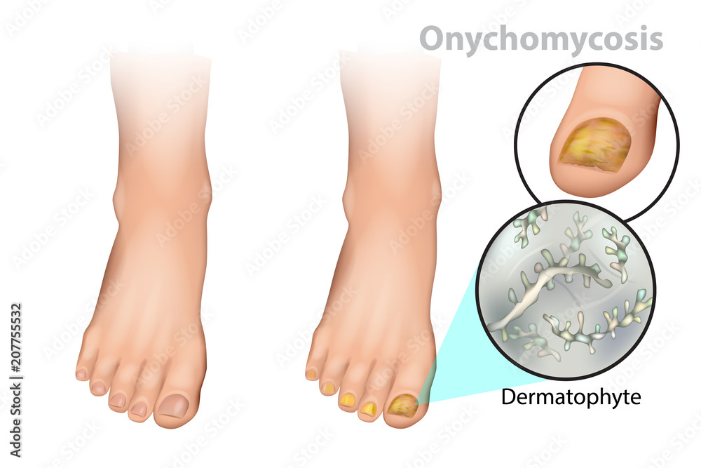 Onychomycosis or tinea unguium. Fungal nail infection. Dermatophyte Stock  Vector