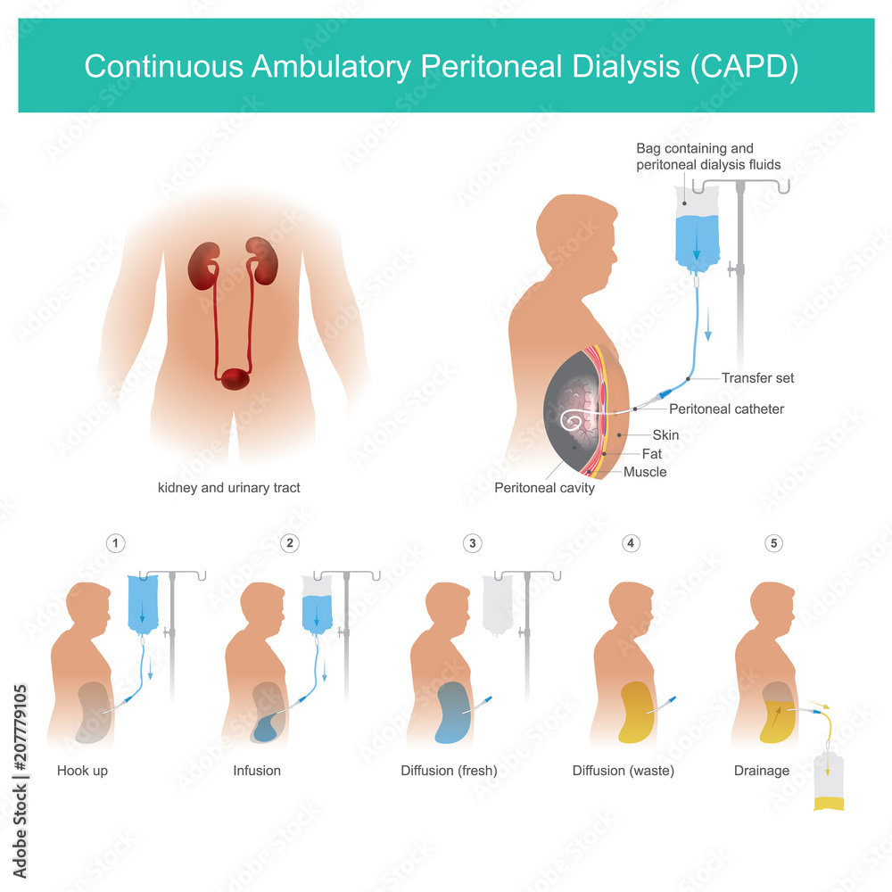 continuous-ambulatory-peritoneal-dialysis-capd-stock-vector-adobe-stock