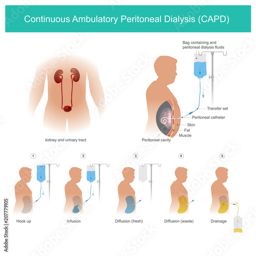 Continuous Ambulatory Peritoneal Dialysis CAPD