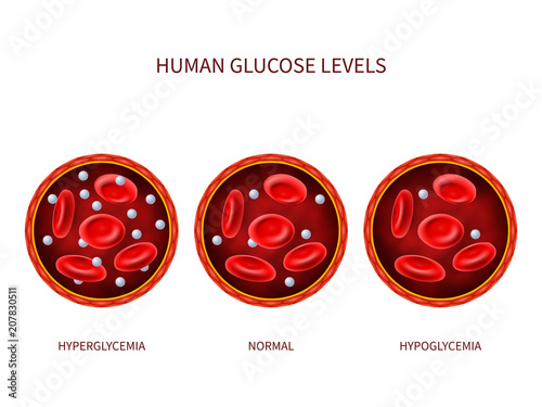 Human glucose levels hyperglycemia, normal, hypoglycemia. Hematology vector diagram with blood vessel, erythrocytes and sugar