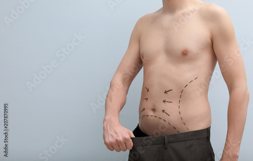 Young man with marks on belly for cosmetic surgery operation on light background
