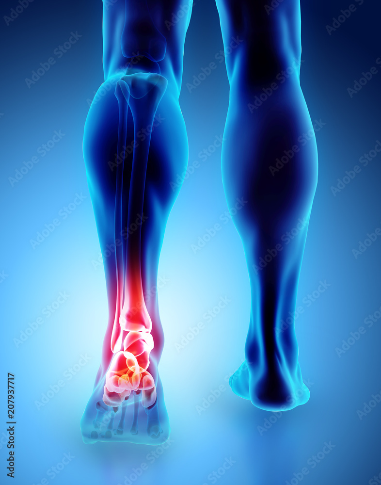 Ankle painful - skeleton x-ray. Ankle painful - skeleton x-ray.
