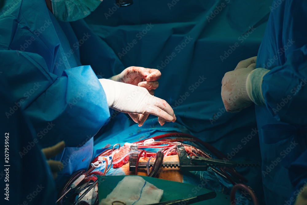 Surgeon close-up of his hands doing septal myectomy procedure for ...