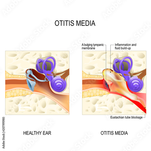 Otitis media