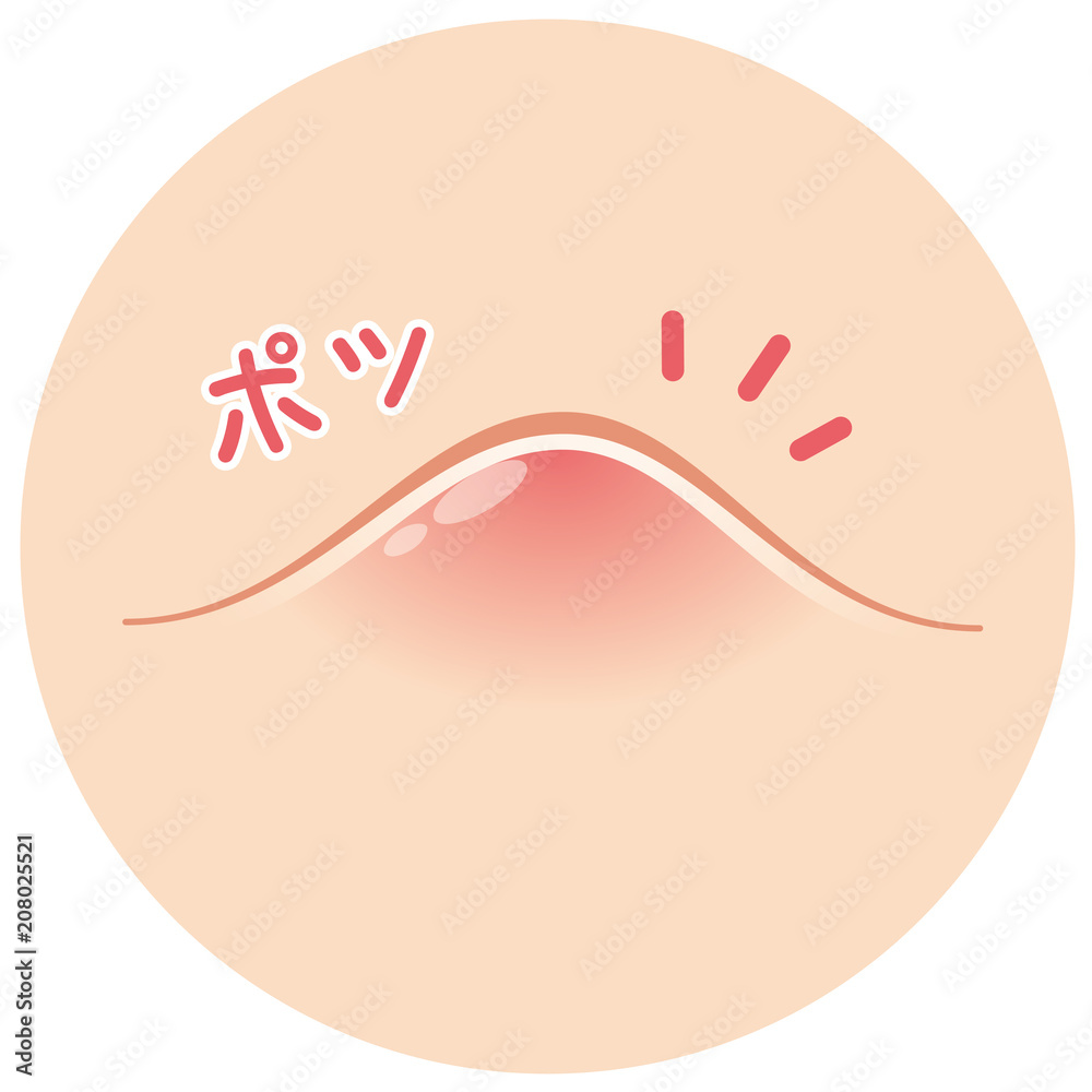 ニキビ 吹き出物 ニキビ 吹き出物