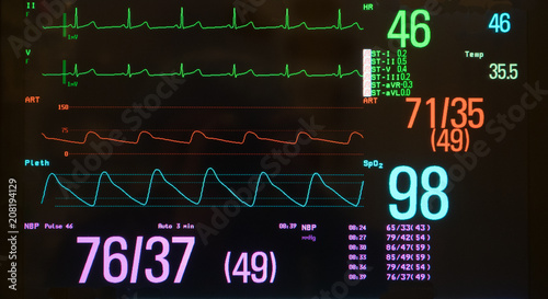 Monitor with Bradycardia on the ECG and Hypotension on the red arterial line.  photo