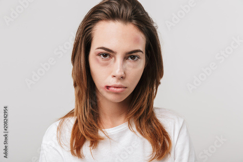 Disabled young girl with scratches and bruises on her face