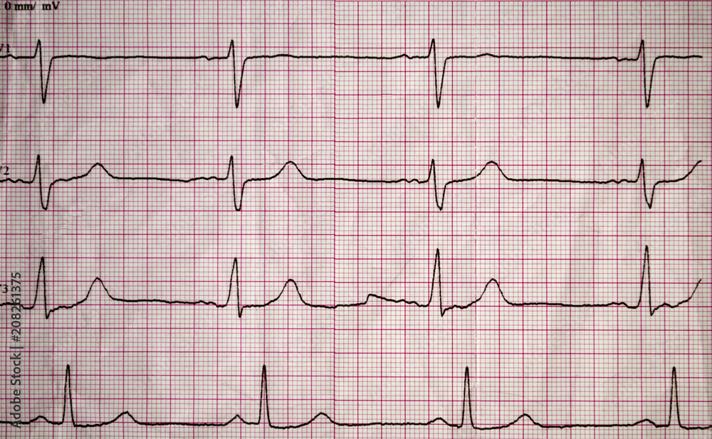Real tape with the cardiogram of man. Image of Electrocardiogram close-up. Real tape with the cardiogram of man. Image of Electrocardiogram close-up.
