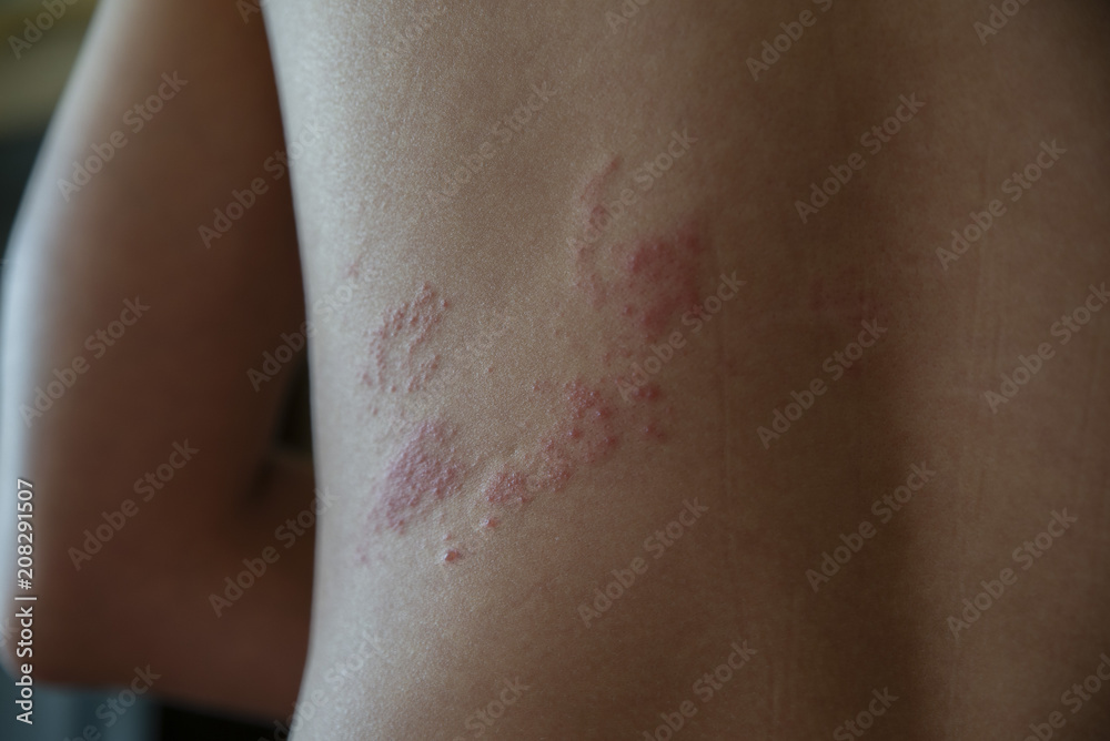 close up on zoster disease on human skin close up on zoster disease on human skin