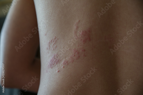 close up on zoster disease on human skin