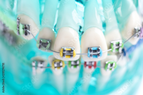 Dental metal brace teeth model