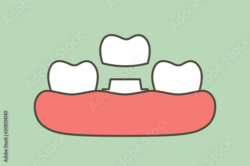 dental crown, installation process and change of teeth