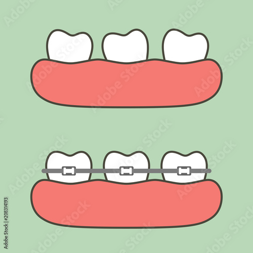 step of orthodontics treatment, before and after