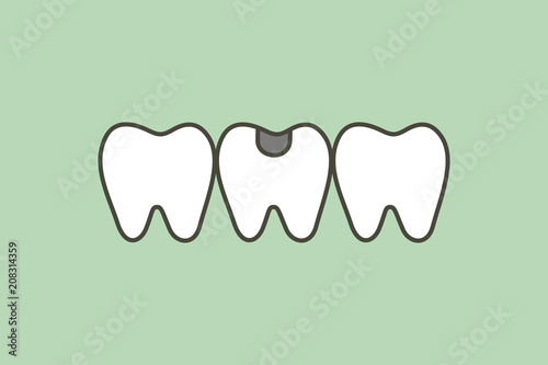 decay tooth or dental caries