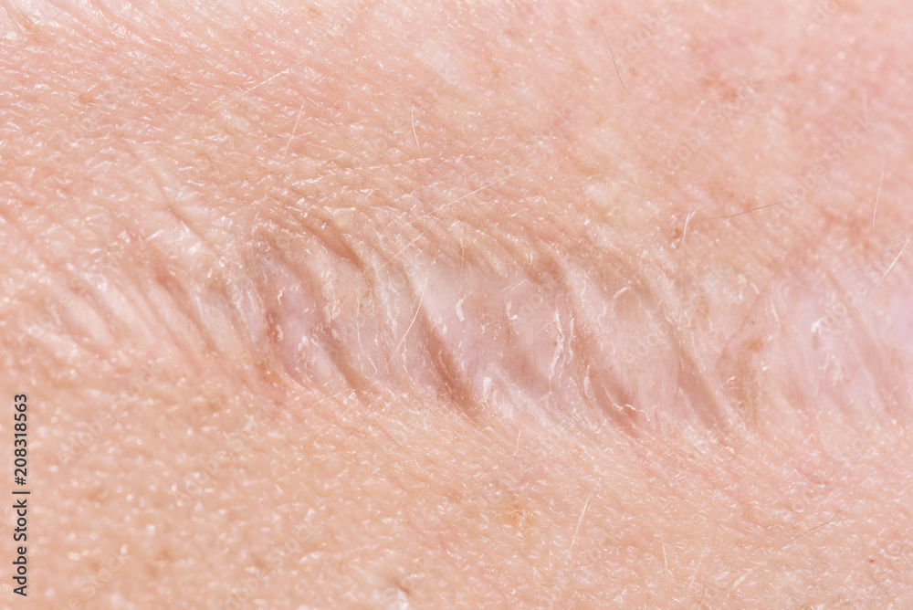 Fototapeta premium scar on the skin