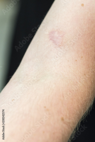 The scar on the arm.
