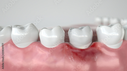 Caries in three stages - Stage 1 Gingivitis - 3D Rendering photo