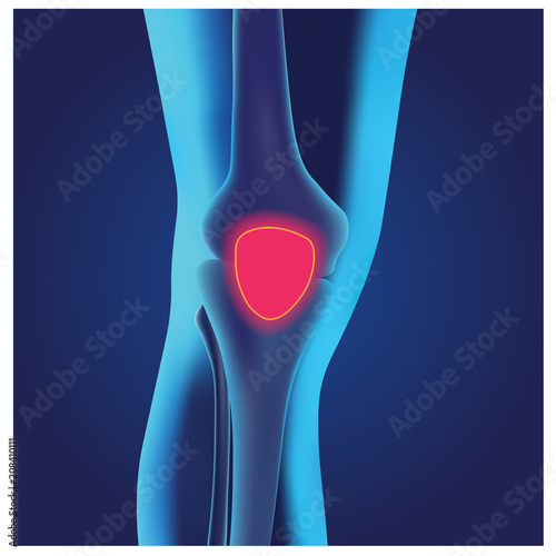PAINFULL KNEE