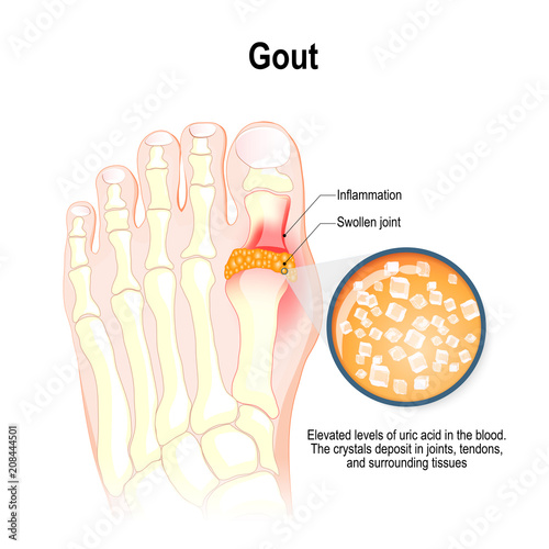 Gout is a form of inflammatory arthritis. photo