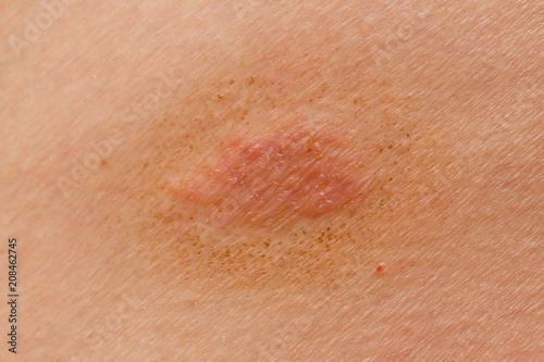 Tableau sur toile Ringworm on the skin of a person