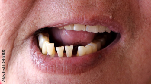 Clouse- up crooked teeth of woman aged 72