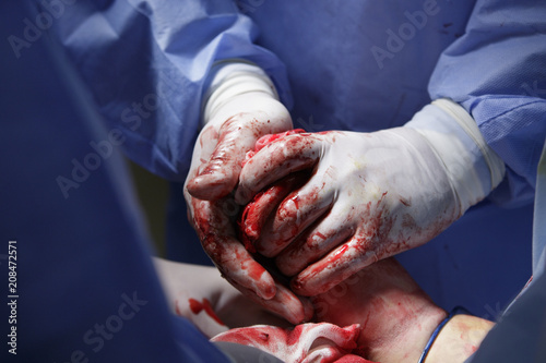 Surgeon compresses the hand stump after the amputation with his bloodstained gloves close-up