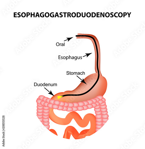 Esophagogastroduodenoscopy. Upper endoscopy. Fibrogastroscopy. Diagnosis of esophageal, stomach, duodenum, intestine, colon. Vector illustration on isolated background