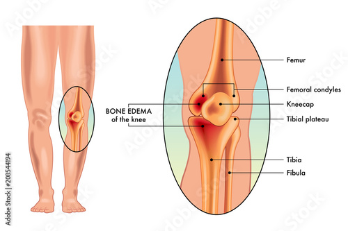 A vector medical illustration of the symptoms of a bone edema on a knee