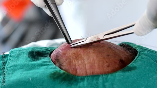Doctor suturing cut wound at forehead. 
