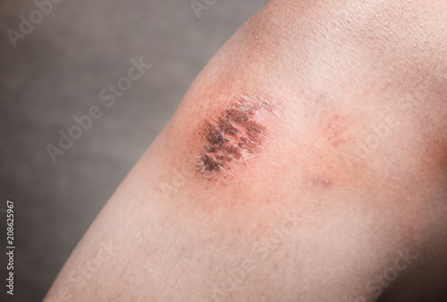 Tableau sur toile Woman having a covering of dried blood or scab on her knee