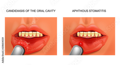 candidiasis and aphthous stomatitis photo