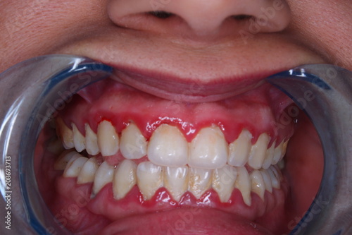 фотографія inflammed gingiva