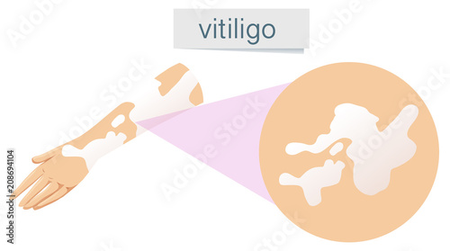 A Vector of Vitiligo on Skin