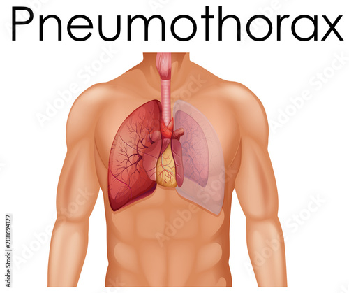 A Human Anatomy of Pneumothorax