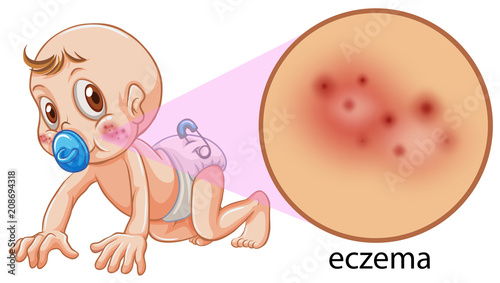 A Vector of Baby Having Eczema