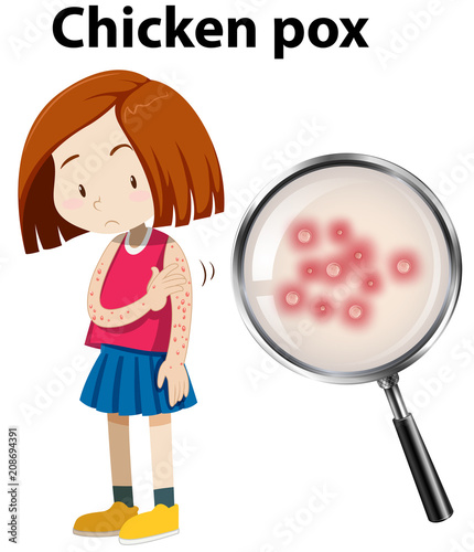 Young girl with Chicken Pox